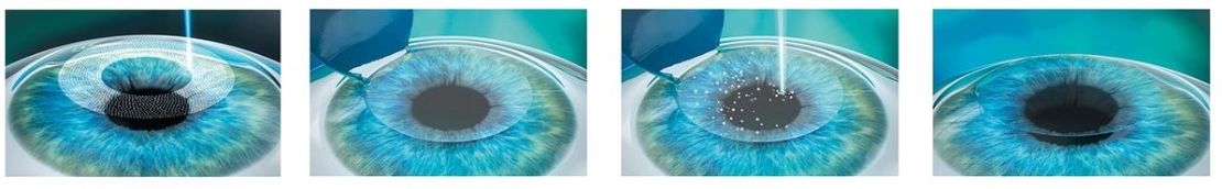 как проходит метод фемто ласик